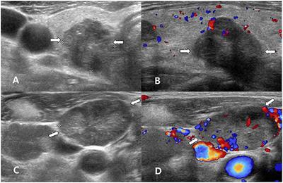 Ultrasonography, Cytology, and Thyroglobulin Measurement Results of Cervical Nodal Metastasis in Patients With Unclear Papillary Thyroid Carcinoma